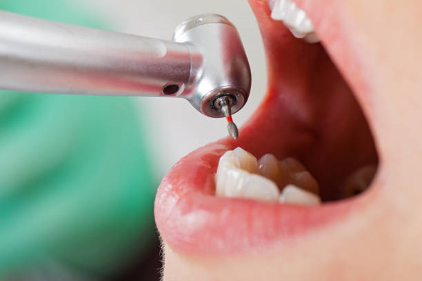 Best Emergency Dentist for Lost Fillings or Crowns in Abingdon, IL